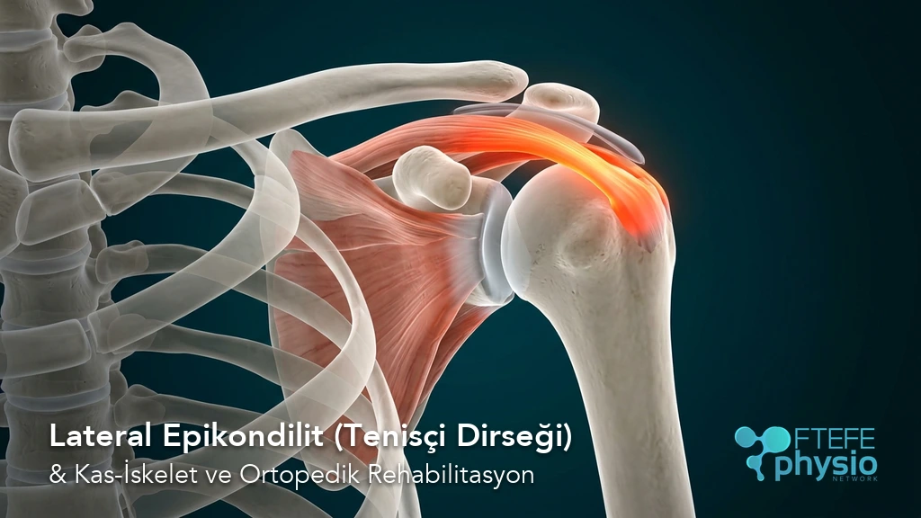 Lateral epikondilit tenisçi dirseği tendon hasarı 3D dirsek modeli