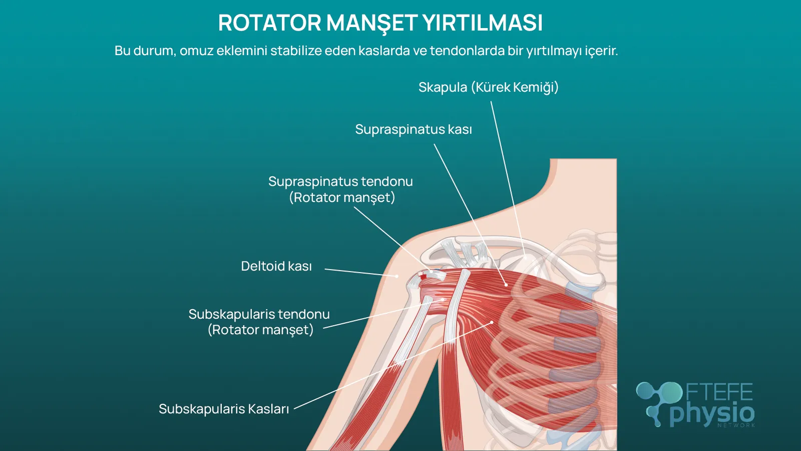 Omuz Rotator Manşet Yırtığını anlatan bir görsel