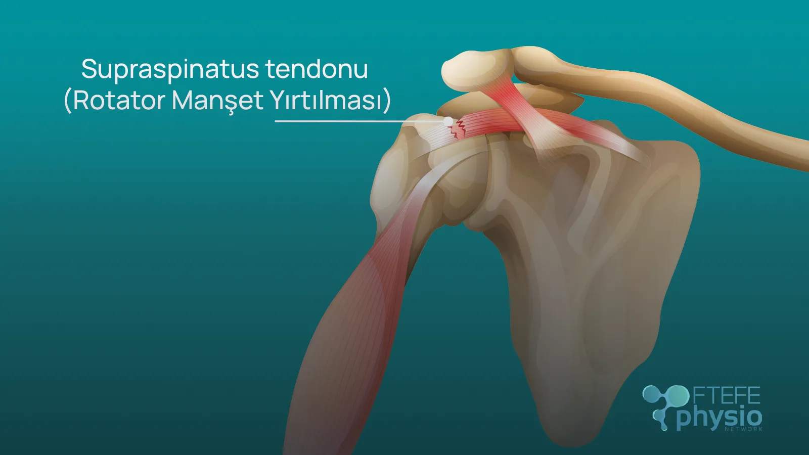 Omuz Rotator Manşet Yırtığını anlatan bir görselOmuz Rotator Manşet Yırtığını anlatan bir görsel